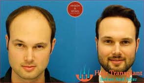 The cost for hair replacement surgery depends cost for hair transplant surgeryon the patient and his specific situation and the number of follicular unit grafts to be while surgical hair transplant is a very good option for men, it is important to mention that it is not a viable solution for most women. Hair Transplant Cost How Much Does Hair Transplant Surgery Cost Fue Hair Transplantation Ha Hair Transplant Cost Hair Transplant Hair Transplant Surgery