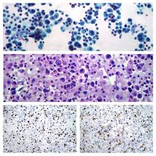Effusion cytology for differential diagnosis of malignant pleural mesothelioma and adenocarcinoma uses immunostaining panels with mesothelial . Effusions Cytopathology Cellnetpathology
