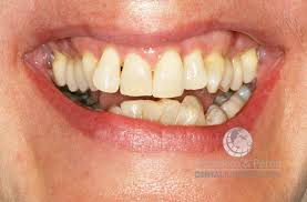 Tratamiento De Ortodoncia En Personas Con Enfermedad Periodontal Centro Dental Internacional Auditorium