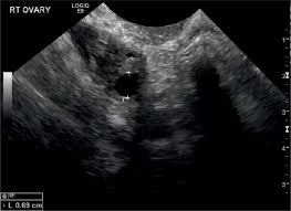 The stages of ovarian cancer are indicated using roman numerals ranging from i to iv, with the lowest stage indicating that the cancer is confined to the ovaries. Sonographic Assessment Of Ovarian Cysts And Masses Chapter 8 Gynaecological Ultrasound Scanning