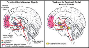 Pgad, though rare, is an incredibly debilitating disease that makes it virtually impossible for the afflicted to carry on their life with any kind of normalcy, said dr. Case Reports Persistent Genital Arousal Disorder A Case Report In A Woman With Lifelong Pgad Where Serendipitous Administration Of Varenicline Tartrate Resulted In Symptomatic Improvement The Journal Of Sexual Medicine