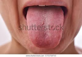 Image result for Fissured tongue