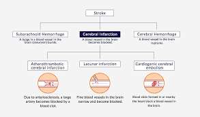 A ministroke, or transient ischemic attack (tia), occurs when part of the brain experiences a temporary lack of blood flow. Ischemic Stroke Healios K K