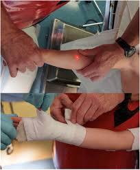 Image result for Short Arm Cast