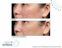 Solta's portfolio includes the thermage rf systems, fraxel laser, clear + brilliant laser and vaser ultrasonic systems. Cb Before After Smac 06 Ageless Remedies