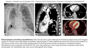 The most common area affected is the lining of the lungs and chest wall. Epos Trade