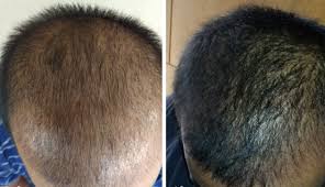 Microneedling is also believed to help induce stem cells in the scalp. Dermaroller Hair Regrowth Surrey Skinvisual Medical Spa