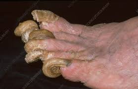 Image result for Onychogryphosis feet