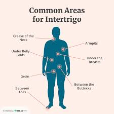 Image result for Intertrigo under breasts