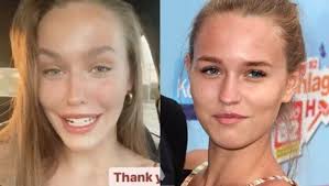 No patch, no stitch cataract surgery dry eye evaluation and treatment management of cornea and external disease Laura Muller Ganz Schon Verandert Unser Beauty Doc Macht Den Check Bunte De