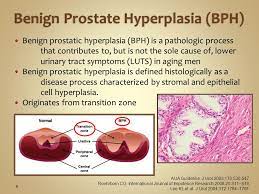 Current Strategic On Bph Management Combination Therapy Ppt Download