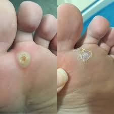 I am in the process of getting rid of planter warts right now, and i must say that it is uncomfortable. Podiatrist Put Beetle Juice On My Wart First Pic Is 10 Days Ago All Blistered Up And The Second Was After Scraping It With A Scalpel Dr Said To Keep Treating With