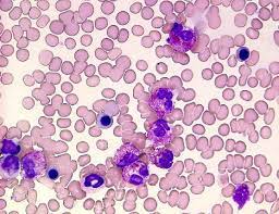 骨髄異形成症候群(myelodysplastic syndrome， mds)症例における赤芽球系細胞の形態異常 59 被型決定 数枚の良好な分裂像を 低倍で良好な分裂像 切り取り核型用紙に並 を選択 ぺる 高倍で写真撮影 残りは写真上で解析する 図1血液. éª¨é«„ç•°å½¢æˆç—‡å€™ç¾¤