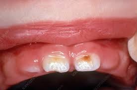 Enamel Hypoplasia Stock Image C039 3019 Science Photo Library