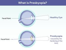 Image result for Presbyopia