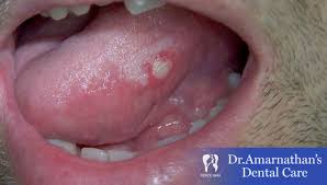 Image result for yellow tongue infection