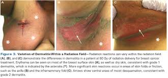 Image result for Radiation Dermatitis