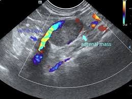 Hyperaldosteronism (Conn's Syndrome) in ...