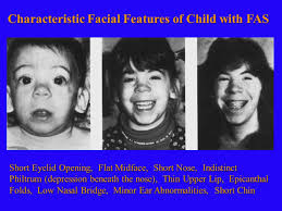 A case of de novo mosaic 18q21.3 deletion with a mild phenotype | mosaicism, phenotype and chromosomes | researchgate, the professional network for scientists. Flat Nasal Bridge And Epicanthal Folds A Case Of Raine Syndrome Presenting With Facial Dysmorphy And Review Of Literature Bmc Medical Genetics Full Text