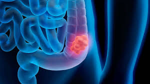Cancer deaths of Americans under 50 have nearly halved -- but not colon cancer