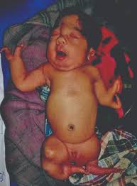 Auch viele schwangere nahmen das. Jcdr Consanguinity Musculoskeletal Malformation Thalidomide