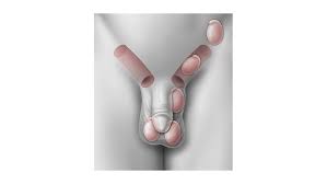 Testosterone release is controlled by the anterior pituitary luteinizing hormone; Undescended Testes Children S Hospital Of Philadelphia