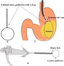 Image result for Bezoar