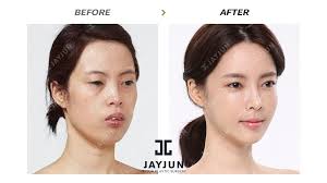 Korean Plastic Surgery Korea Cosmetic Surgery Korean Plastic Surgery Before And After Cosmetic Sur Plastic Surgery Korea Korean Plastic Surgery Plastic Surgery