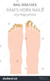 Image result for Onychogryphosis feet