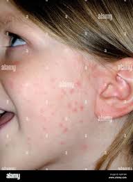 poison ivy toxicodendron rhus radicans dermatitis skin rash Stock Photo