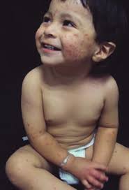 Síndrome de Gianotti-Crosti o acrodermatitis papular de la infancia