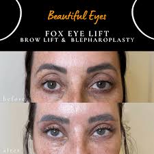 Cosmetic Upper Eyelid Surgery (Blepharoplasty)