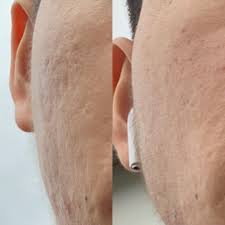 Acne scars before and after reddit. Skin Concerns Acne Scar Progress Skincareaddiction