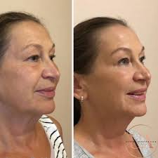 Benefiting Skin Boosters Profhilo Billericay