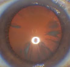 De eerste symptomen van cataracta corticalis of schorstroebeling zijn straalvormige vertroebelingen in het buitenste corticaal gedeelte van de lens. Augenarzt Dr Gunther Wohlmuth In 1210 Wien Fotosammlung