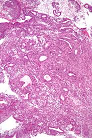 Polyp of stomach and duodenum. Endometriumhyperplasie Wikipedia