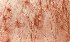 Image result for pubic lice symptoms