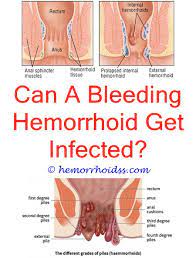Can Hemorrhoids Burst Cure For Hemorrhoids Bleeding Hemorrhoids Hemorrhoids Treatment