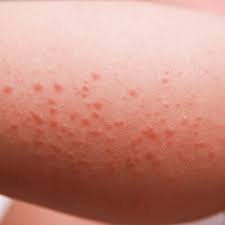 Image result for sweat rash on back