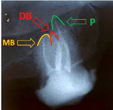 Maybe you would like to learn more about one of these? Access Cavity With Demonstrating Arrows Mp Mesiopalatal Dp Download Scientific Diagram