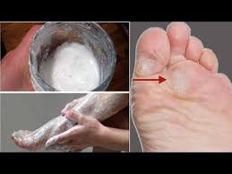 Calo Seco No Dedo Do Pé Elimine Calos E Rachaduras Em Pouco Tempo Aplicando Este Remedio Caseiro Dicas De Saude Youtube Saude Da Unha Limpeza De Rosto Calos