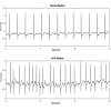 Atrial fibrillation symptoms often include heart palpitations, shortness of breath and weakness. 1