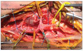 The medial femoral condyle flap is used for treatment of nonunions with or without intercalary bone loss. Anatomic Variability Of The Vascularized Composite Osteomyocutaneous ï¬‚ap From The Medial Femoral Condyle An Anatomical Study
