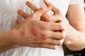Selain garis merah pada kulit, dermatographia sering tidak menyebabkan masalah. 4 Macam Penyakit Alergi Kulit Apa Gejala Dan Cara Mengobatinya
