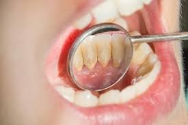 How can i fix white spots on my teeth? How To Prevent And Remove Tartar Calculus Plaque From Teeth