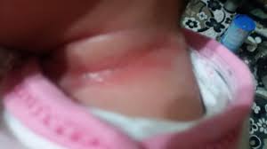 bebeklerde boyun pisigine ne iyi gelir sorcev