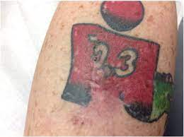 The number of skin cancers arising in tattoos is seemingly low, and this association has to be considered thus far as coincidental. A Case Of Multiple Squamous Cell Carcinomas Arising From Red Tattoo Pigment Sciencedirect
