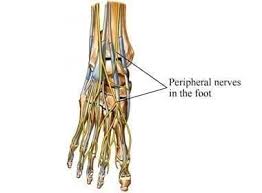 Image result for Peripheral Neuropathy