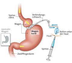 Magenband Adipositas Wiki Shg Bariatrische Chirurgie