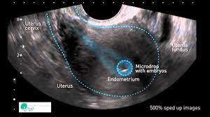 Typen und klassifizierung nach qualität. Ausruhen Nach Dem Embryotransfer Der Fruchtbarkeits Blog